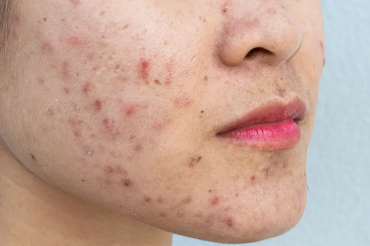 Understanding Acne Basics